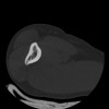SPORK, NICO - 22.03.1976 - 02.08.2022 - CT obere Extremität - 17:59:38